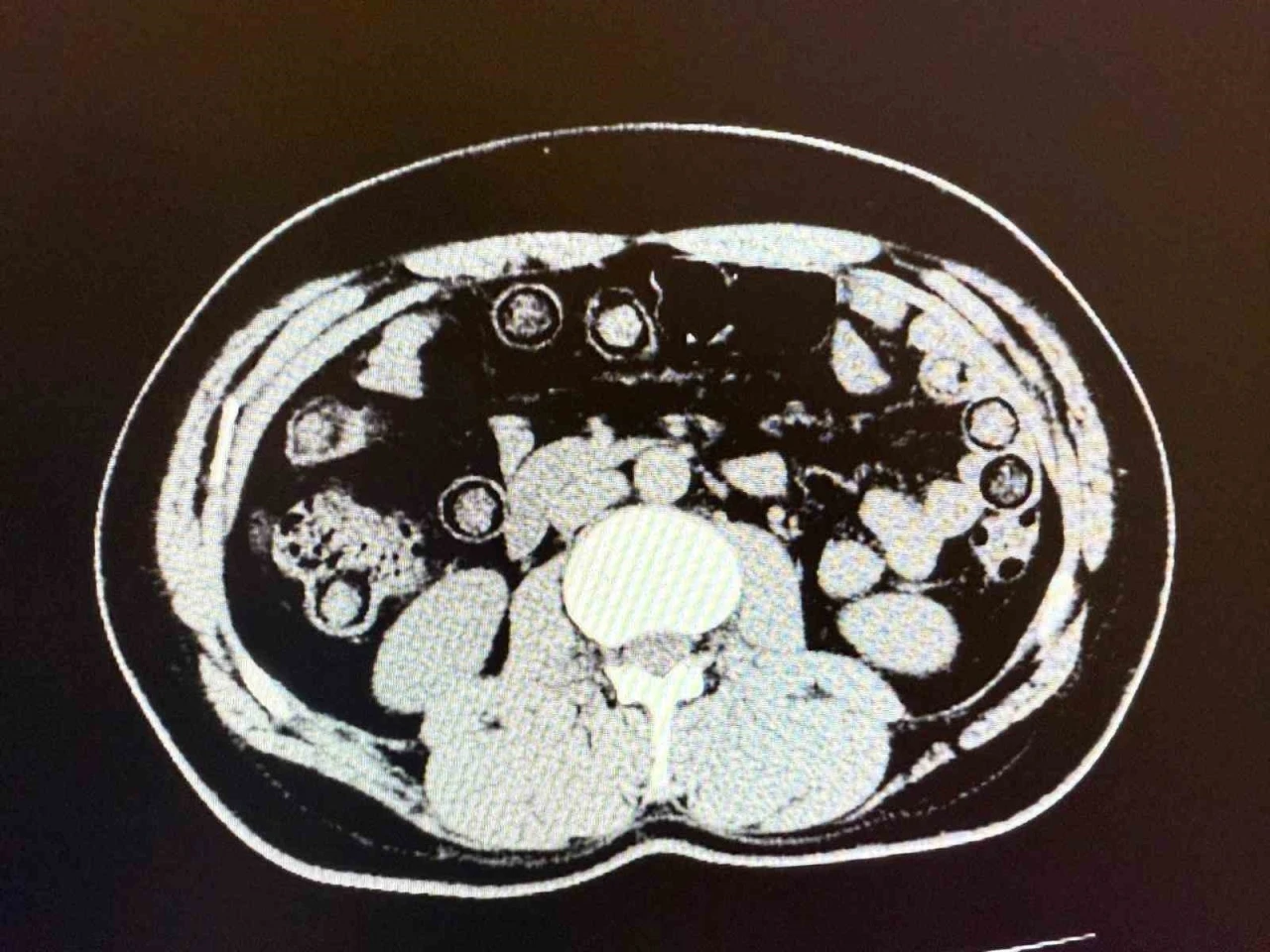 Muş’ta midelerinden 928 gram uyuşturucu çıkan 2 İranlı tutuklandı
